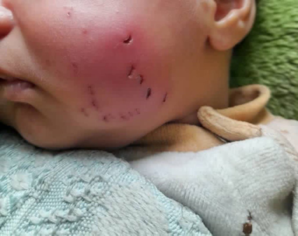 Toddler bitten by rat in Gaza tent, now in ICU