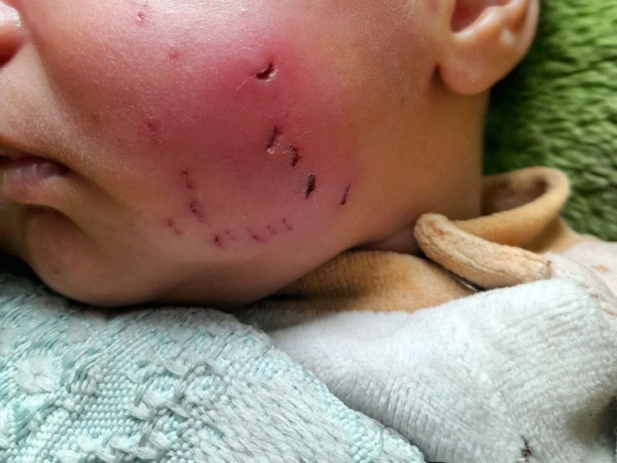 Gaza: Large rodent attacks infant in displacement tent