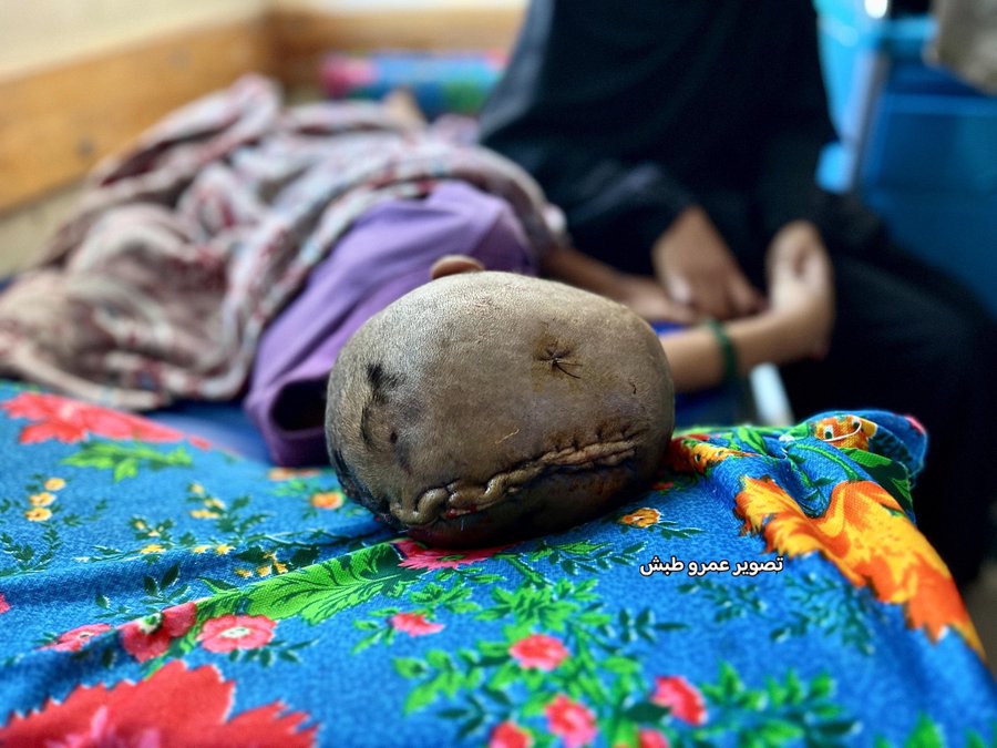 Palestinian child paralyzed after Israeli army shooting