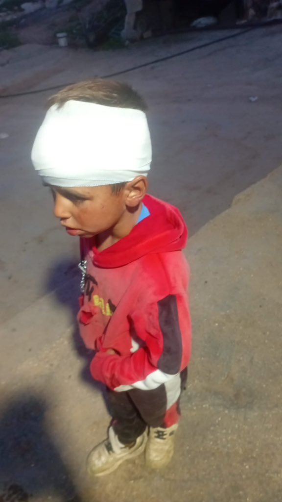 Palestinian boy wounded by Israeli settlers in Masafer Yatta