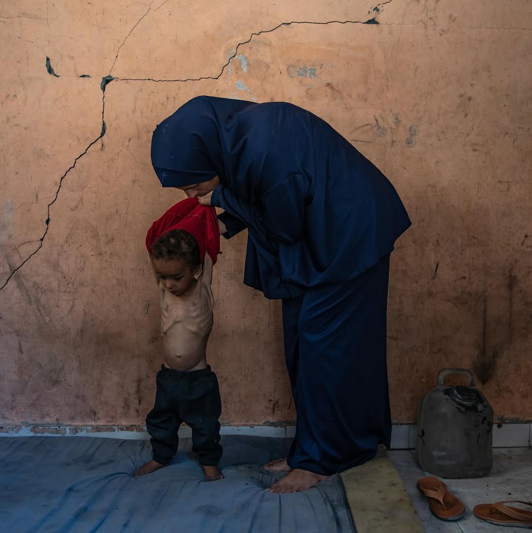 Two-year-old child suffering from severe malnutrition in Gaza