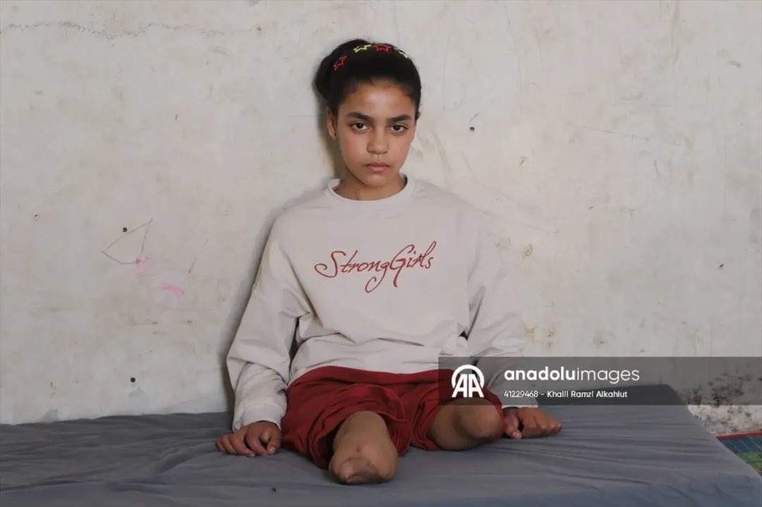 Palestinian Girl Dreams of Walking After Israeli Attack