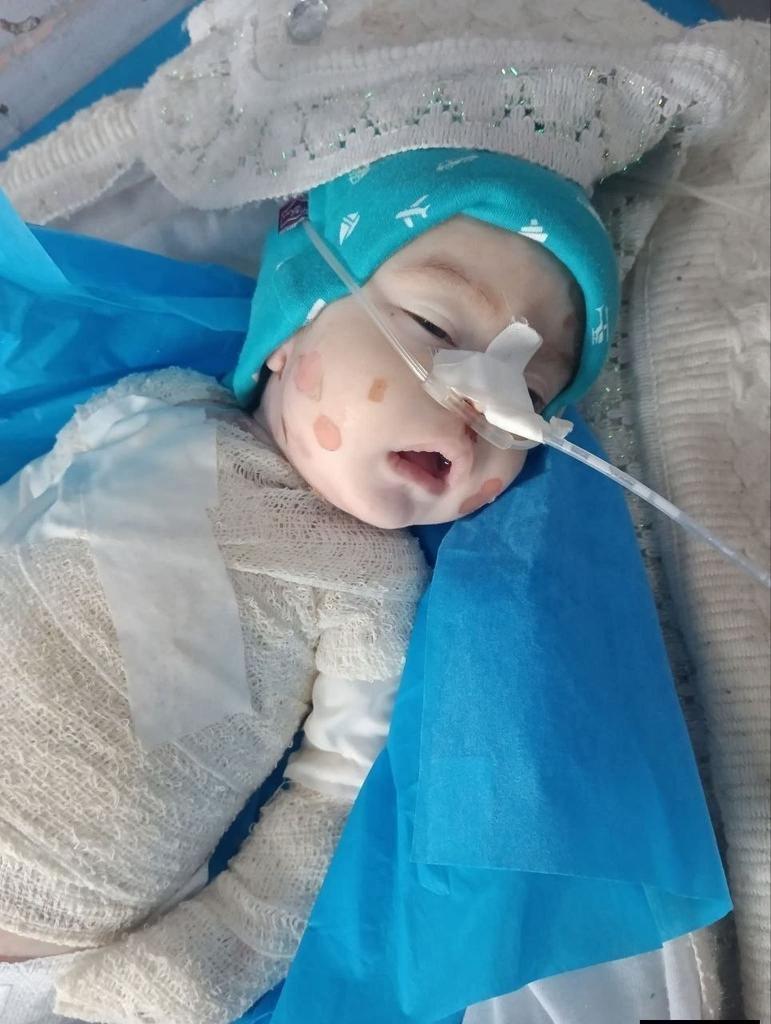 Child Dies from Rare Skin Disease After Gaza Travel Delay
