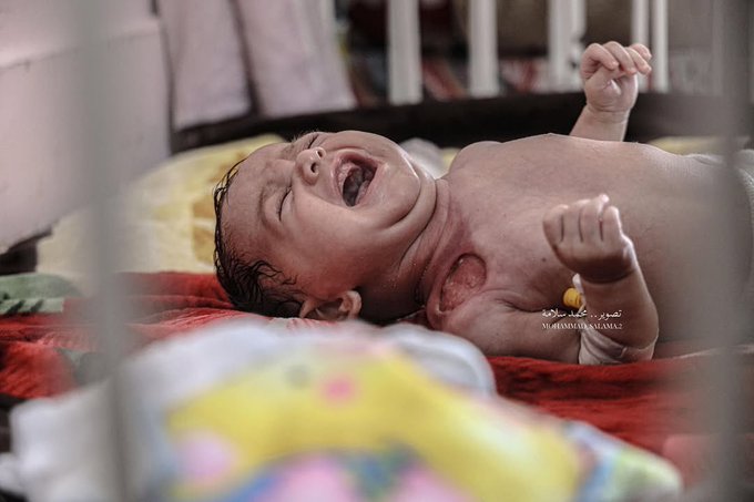 Two-Month-Old Baby Salma Needs Urgent Medical Treatment for Immune Deficiency