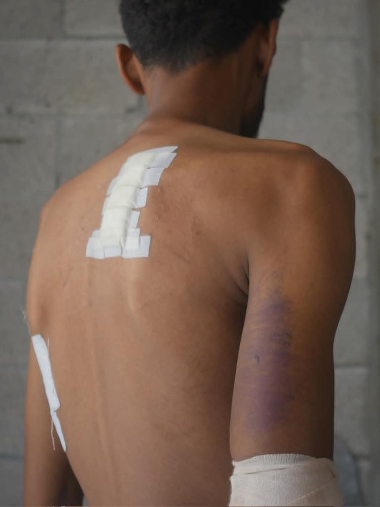 Journalist reflects on survival and loss after severe hand injury