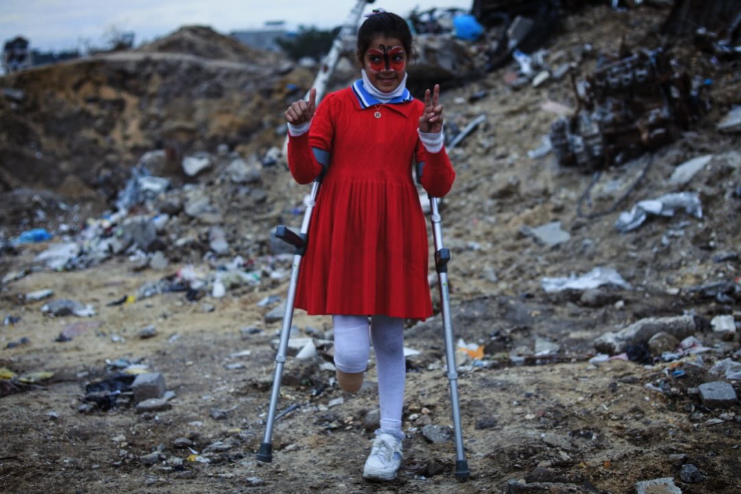 Child loses parents and leg in Israeli strikes on Gaza