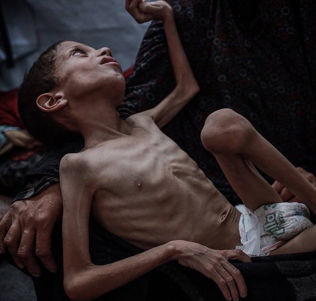 10-Year-Old Child Nafez Mohammed Nasser Severely Malnourished at 9kg