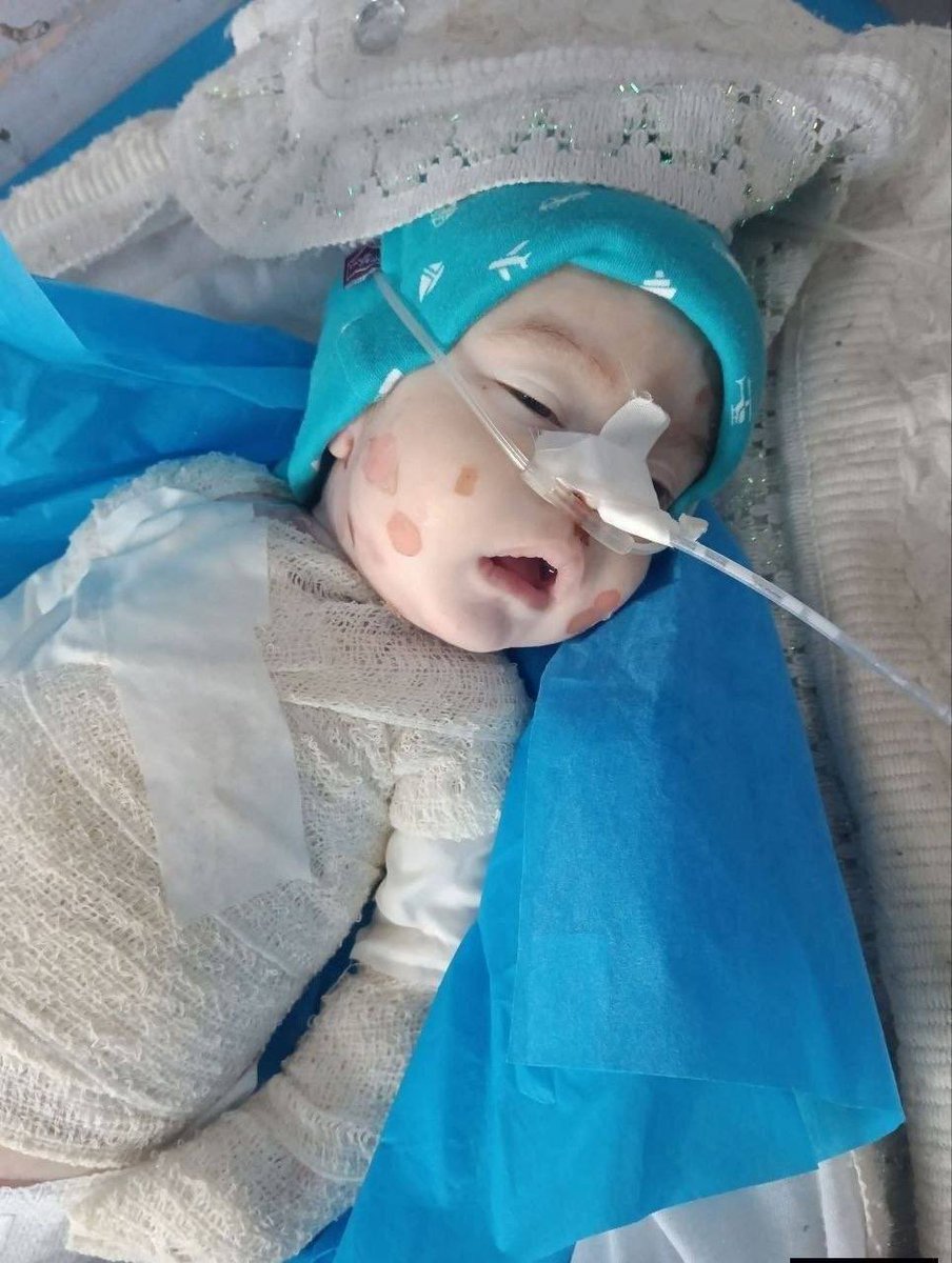 Child Dies After Treatment Delays Due to Rare Bubble Disease