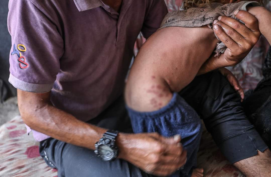 Skin diseases spread among displaced people in Deir al-Balah camps