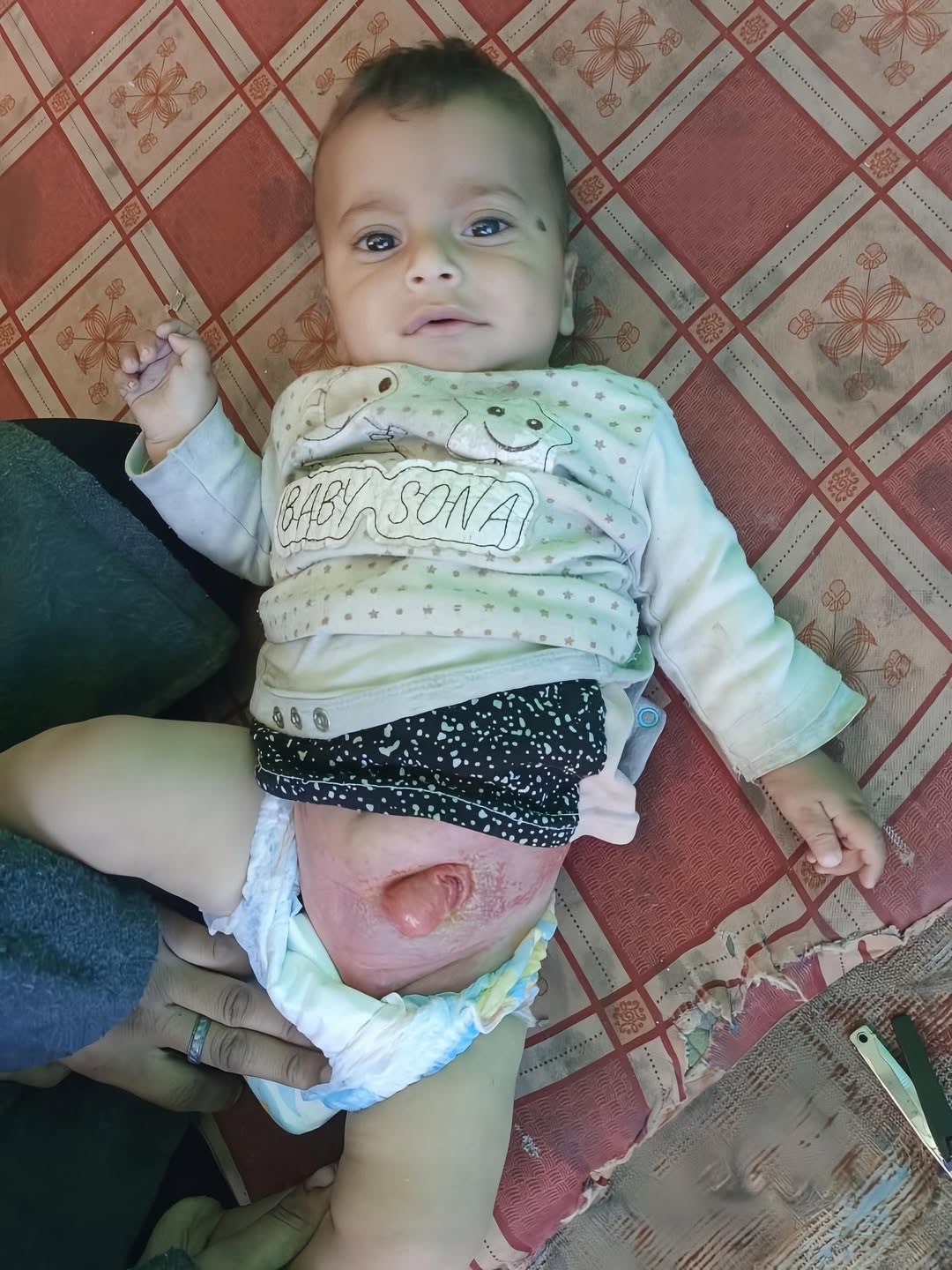 1-year-old child needs urgent surgery for colon condition