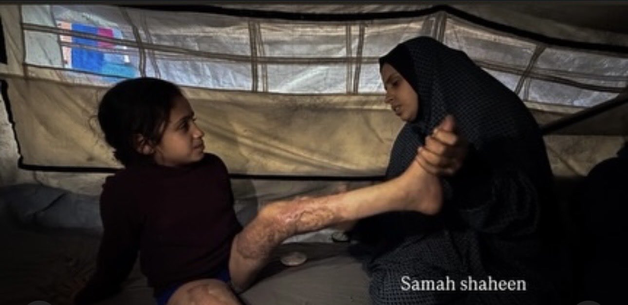 Ranin Suffers Severe Burns from Israeli Airstrike in Gaza