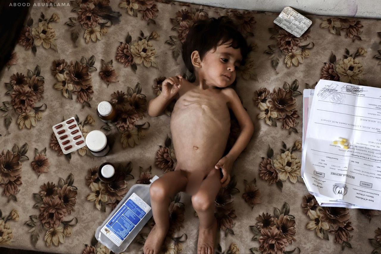 Severe malnutrition in Palestinian child during Gaza blockade