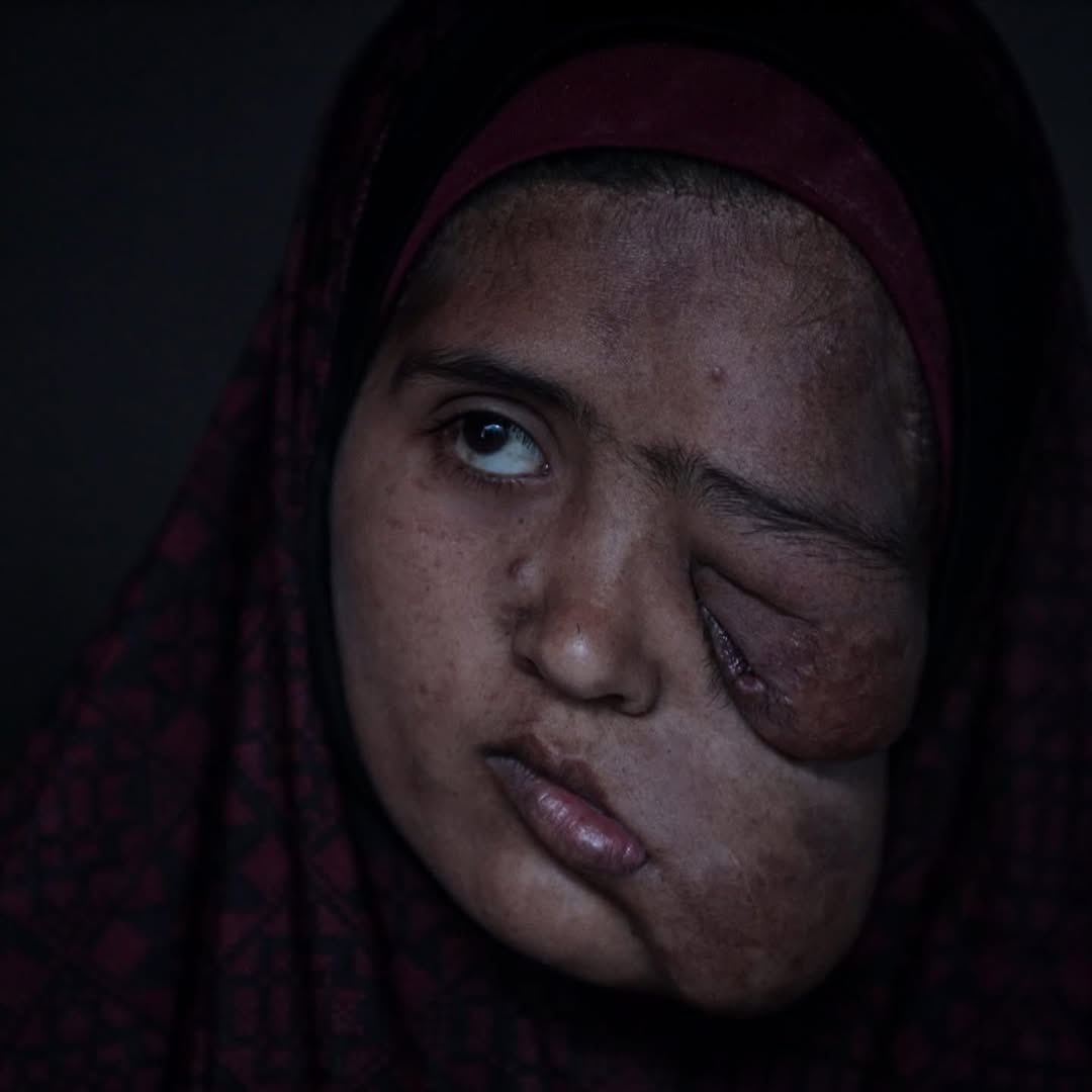 Palestinian Teen with Facial Cancer Denied Treatment in Gaza