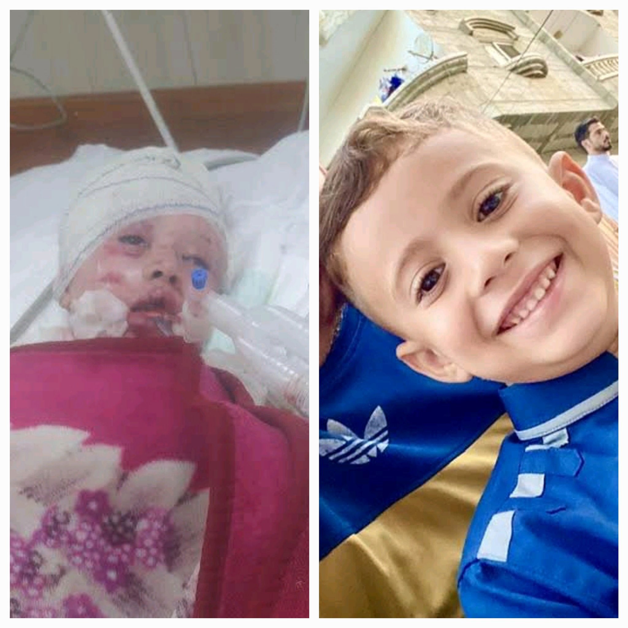 Israeli airstrike survivor child Omar fights for life with severe burns