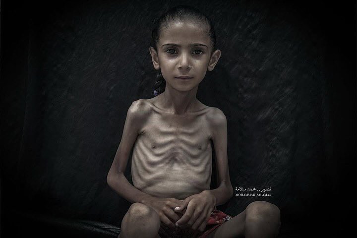 Amal: Child Facing Hunger and Malnutrition in Gaza Blockade