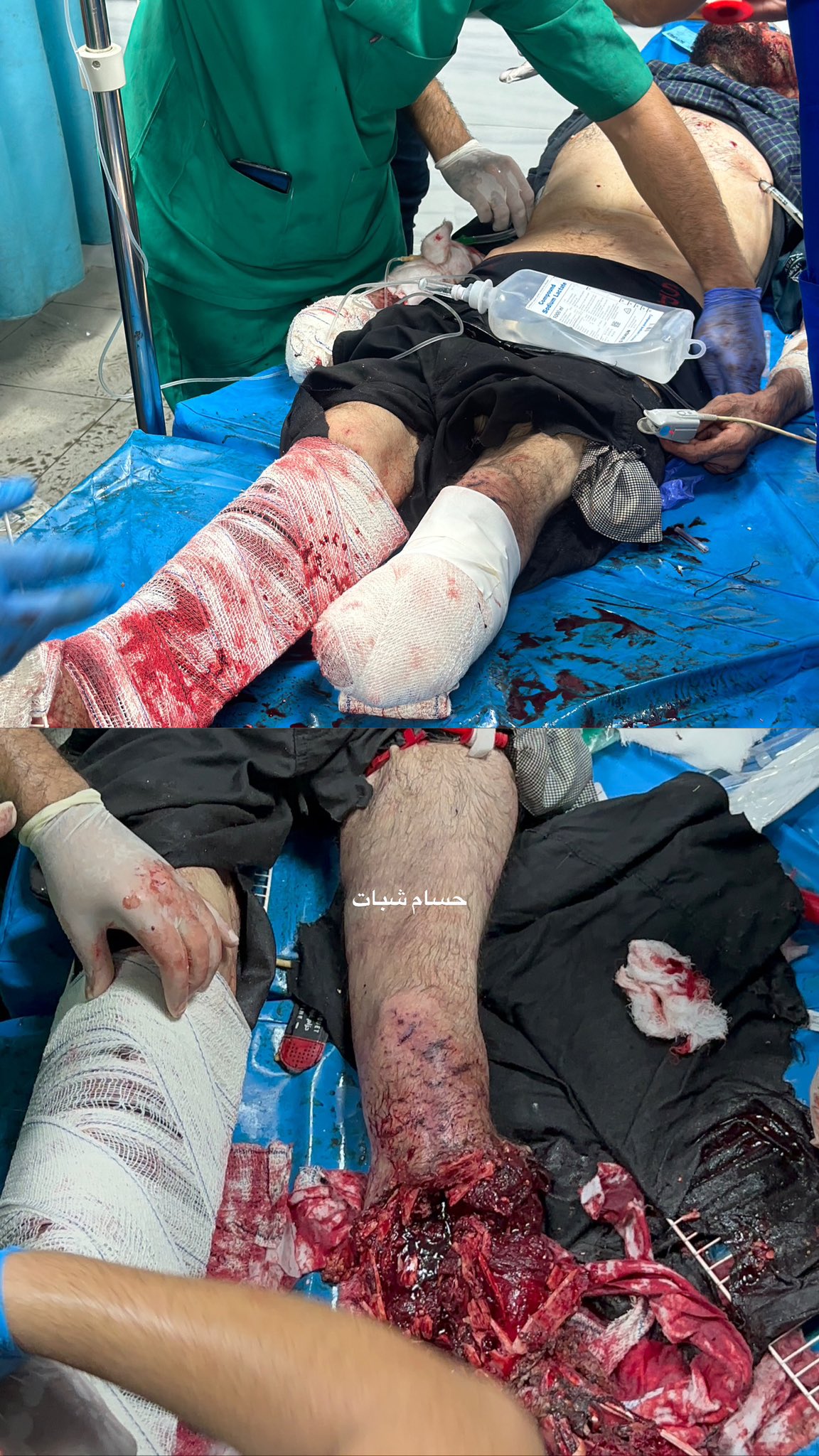 Amputation without anesthesia due to lack of medical resources