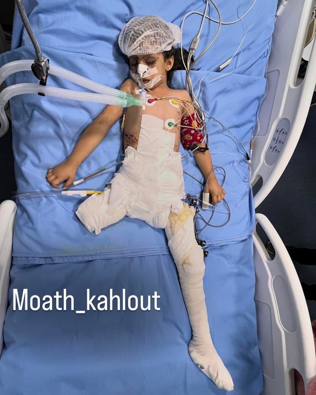Gaza Death Toll: 40,972 Palestinians Killed, 94,761 Injured