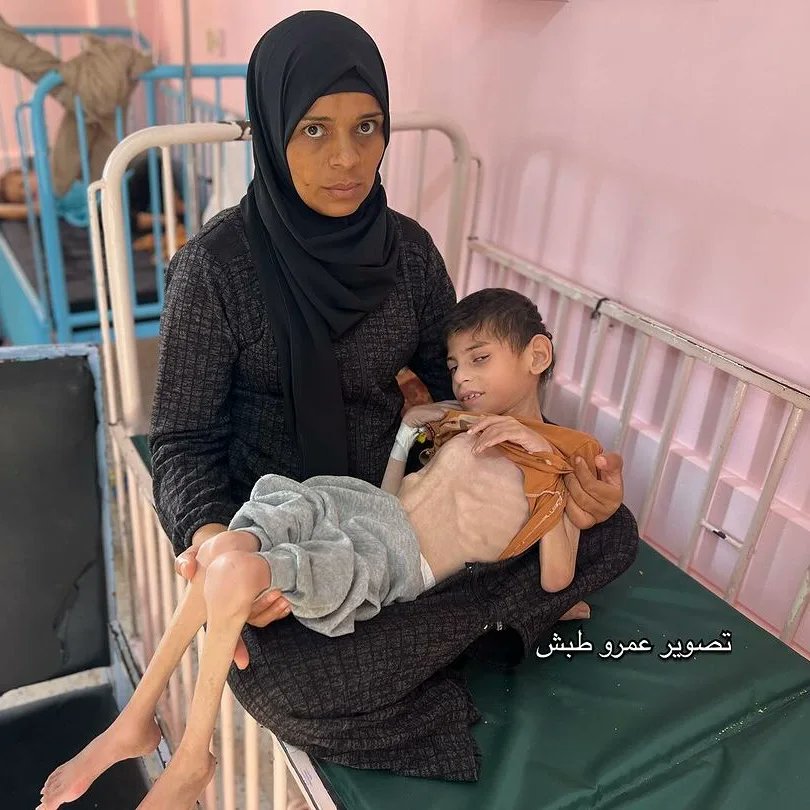 Child suffering malnutrition in Gaza blockade