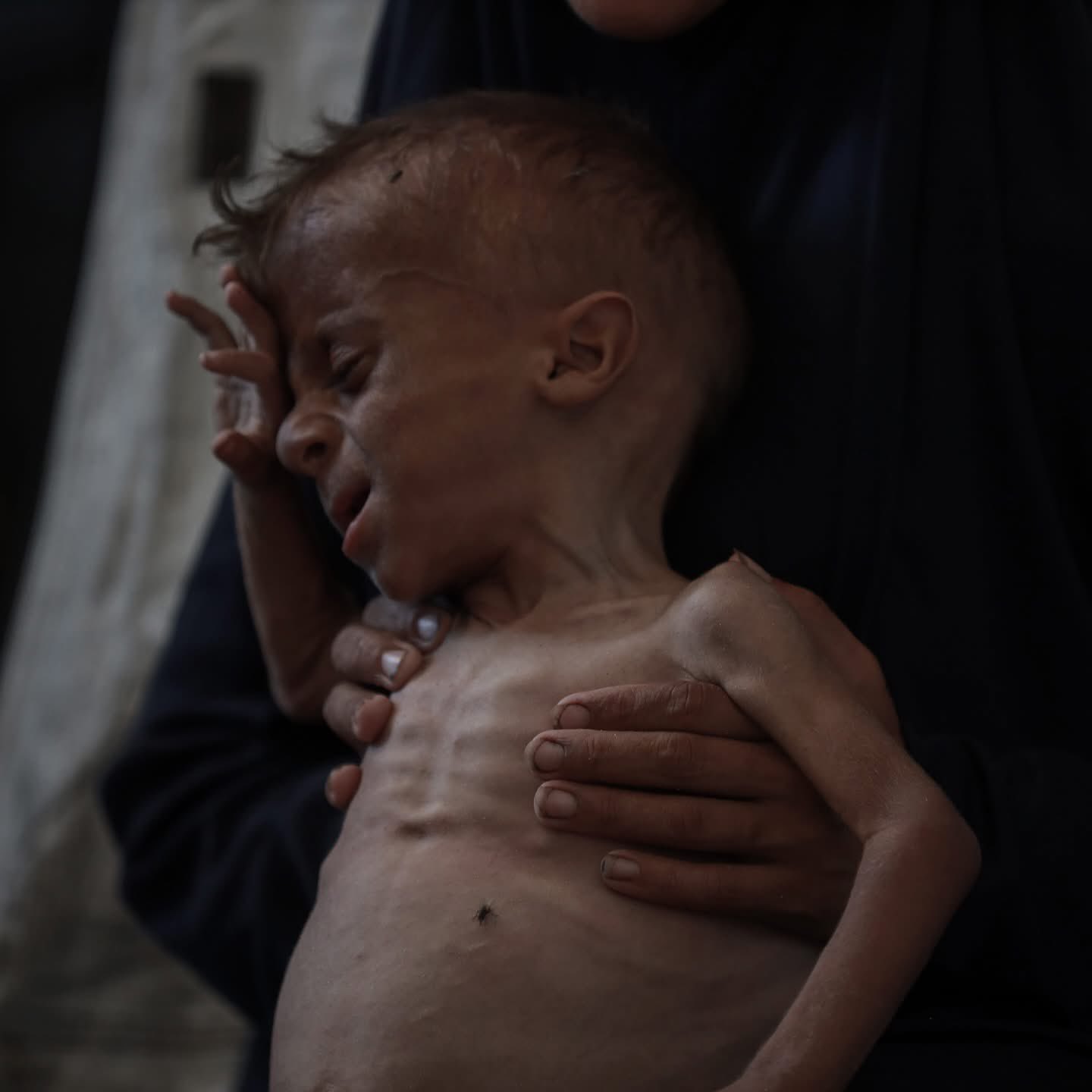 Child Suffering from Severe Malnutrition in Gaza Amid Blockade