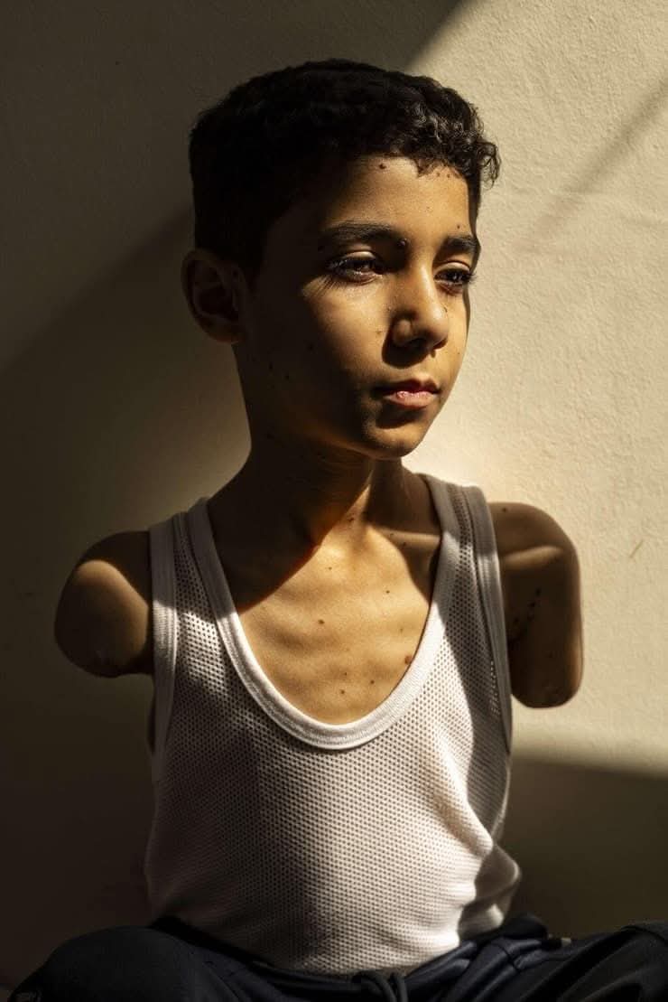 Child amputee’s photo wins World Press Photo award from Gaza