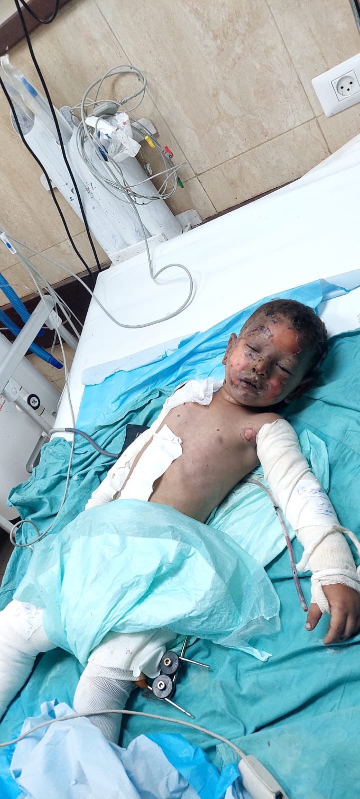 Child Gaith dies from severe burns and wounds
