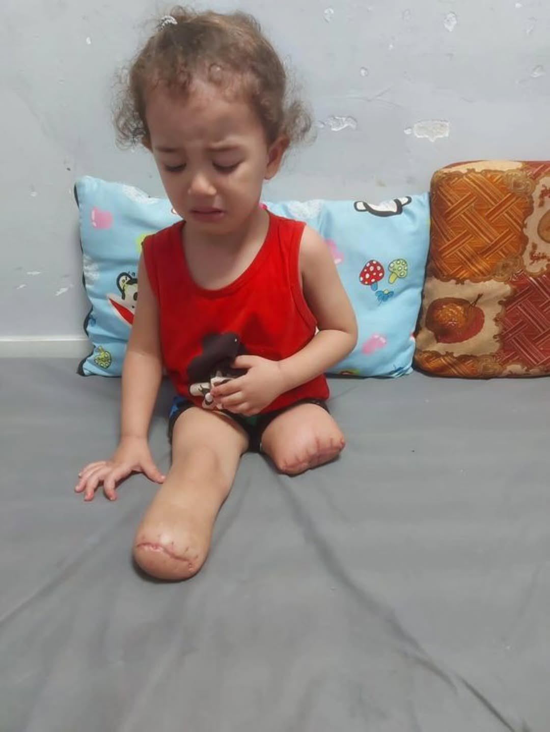 Thousands of children in Gaza have lost limbs amid crisis