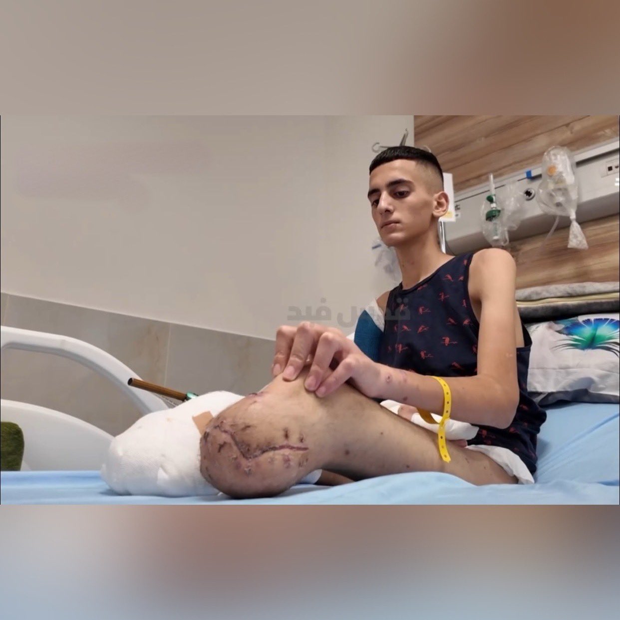 Palestinian Youth Loses Legs in Israeli Drone Attack