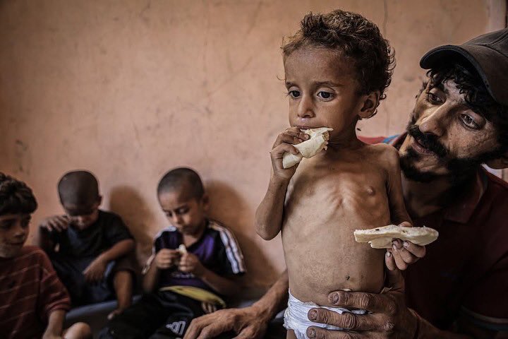 Child in Gaza suffering from severe malnutrition and famine