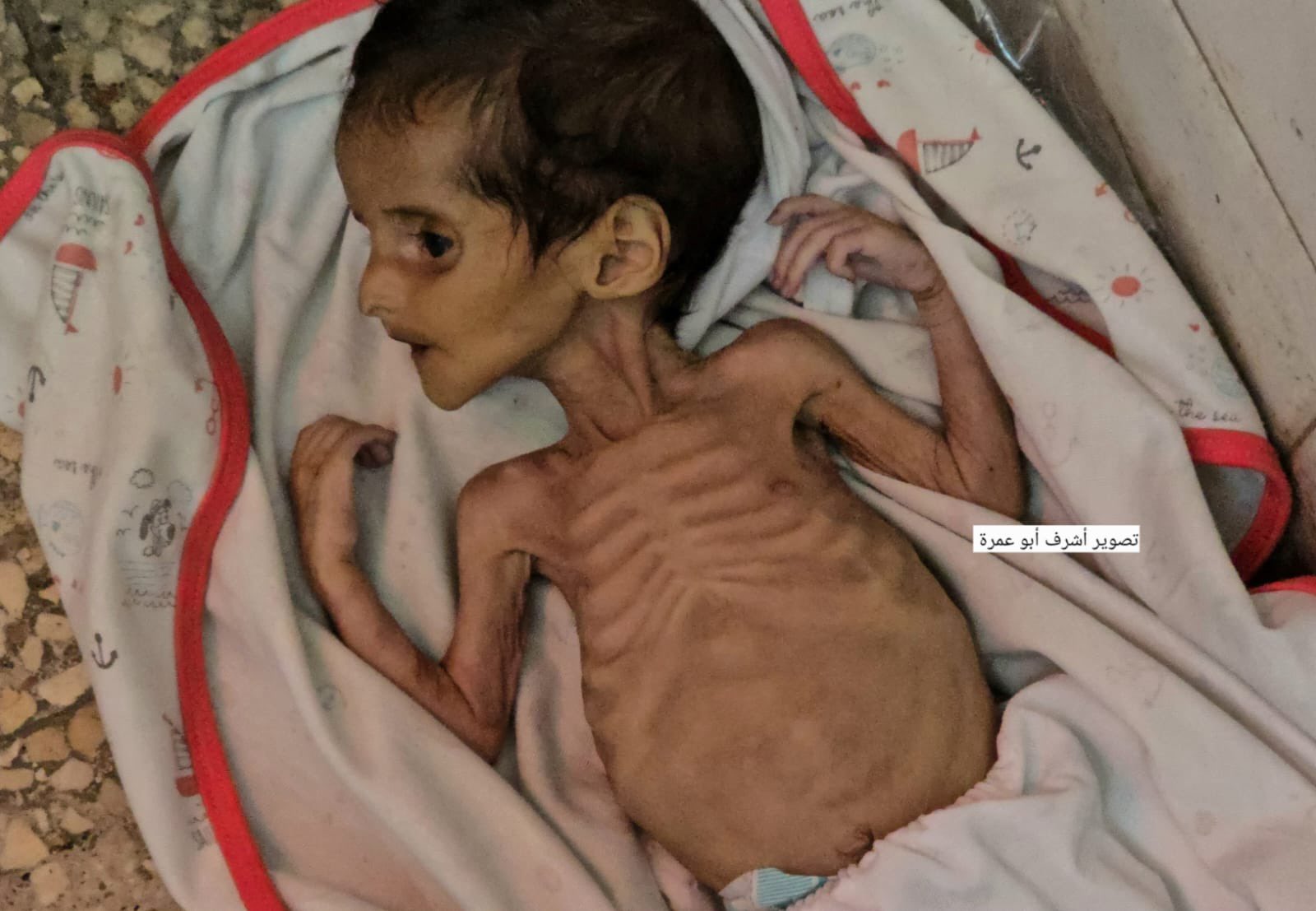 Al Shifa Director Reports Malnutrition Crisis and Child Disease Outbreaks Gaza