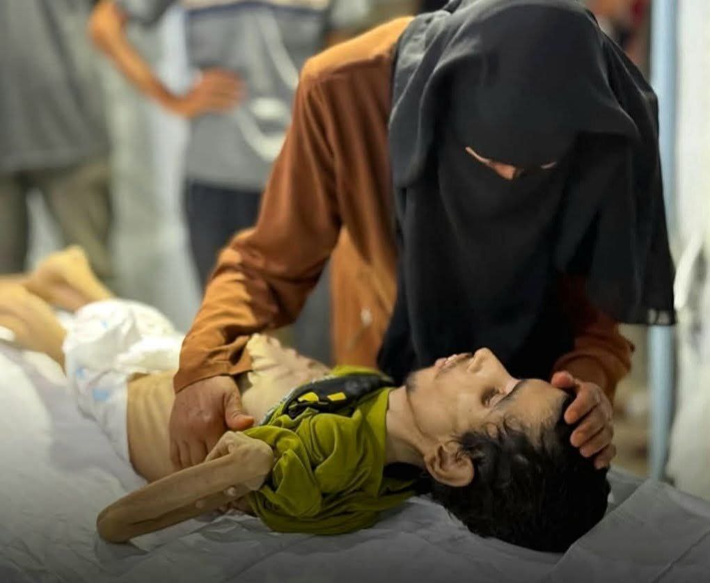 Young Man Dies from Malnutrition During Gaza Siege