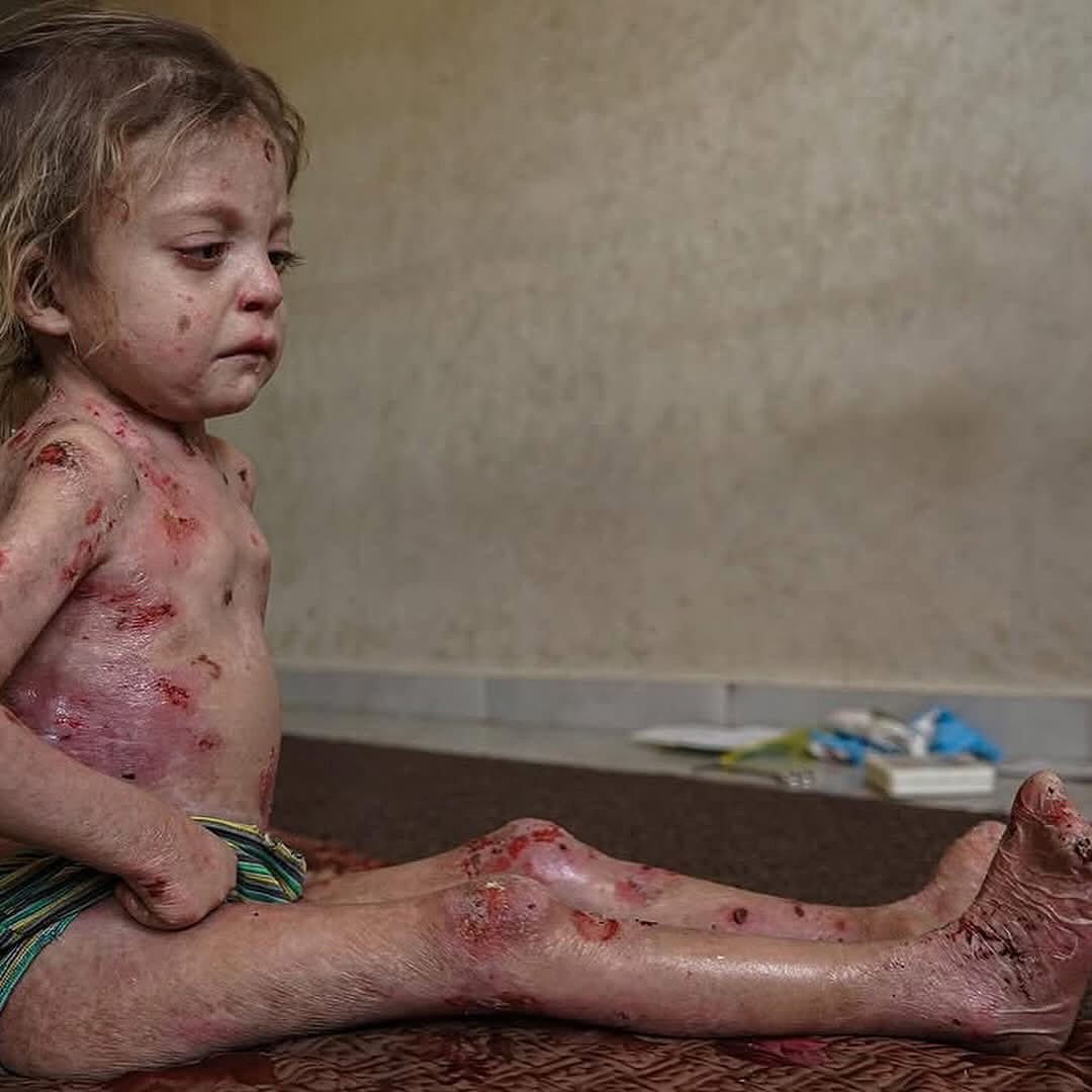 Child with Rare Skin Condition Faces Medical Crisis in Gaza