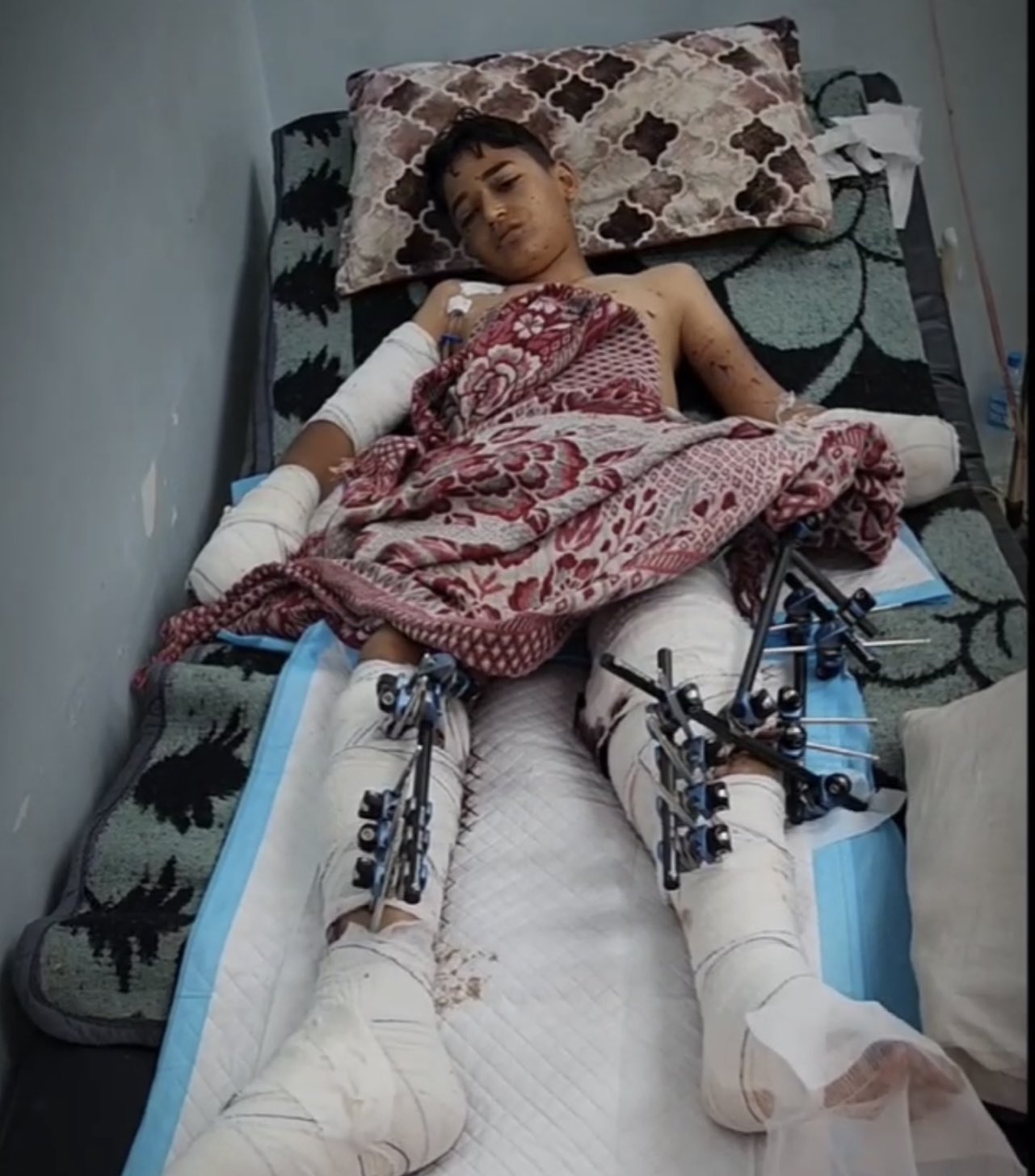 Child casualty from unexploded ordnance in Rafah