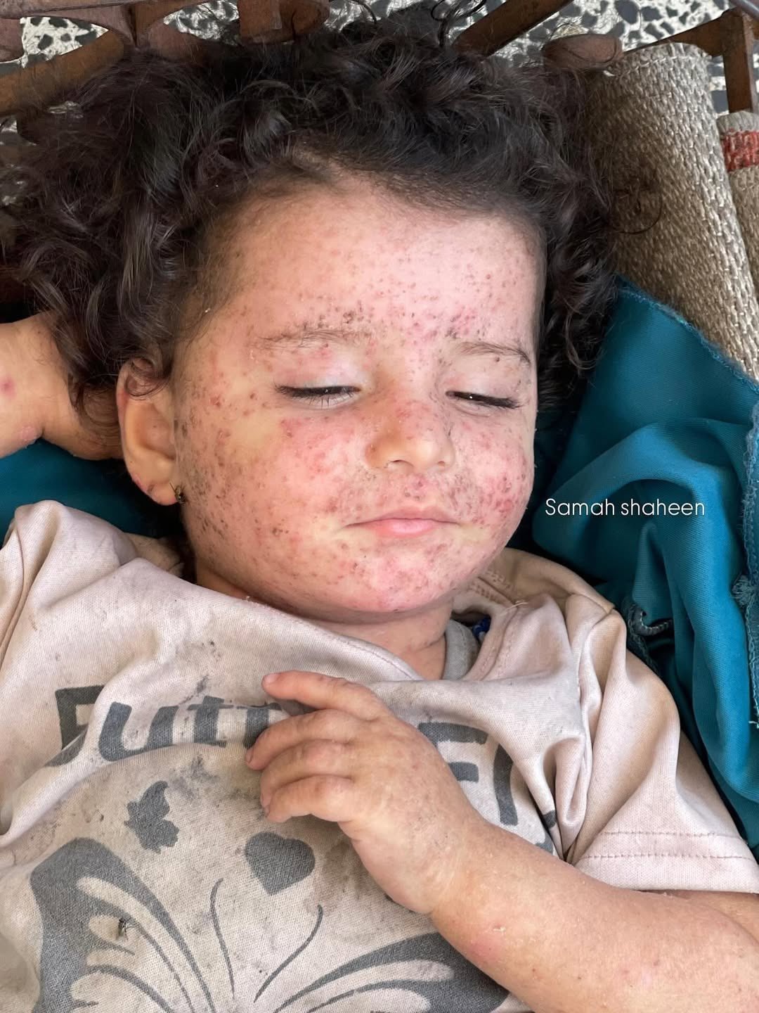 Child suffering from skin disease in Gaza conflict
