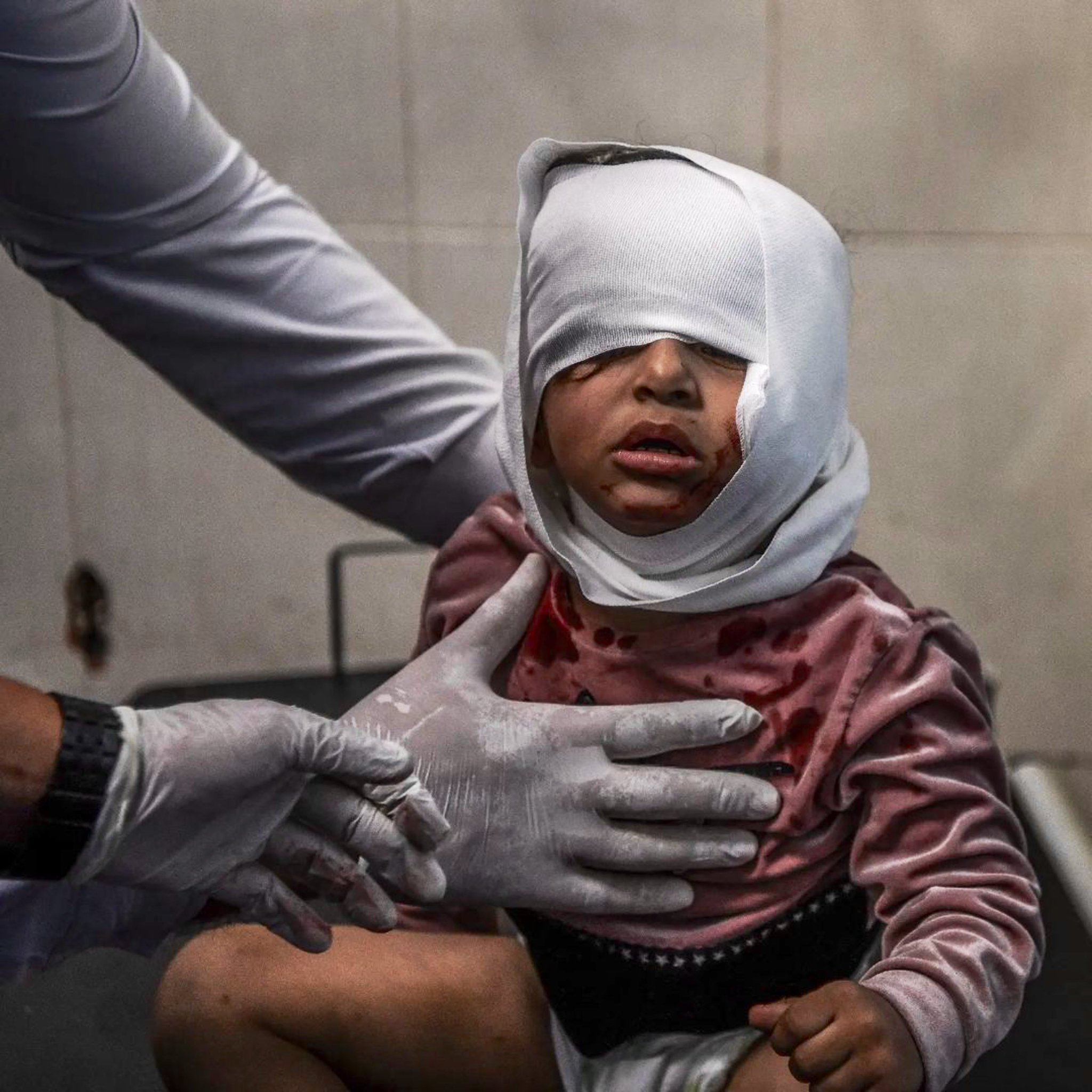Palestinian Child Injured in Israeli Attack Receives Hospital Treatment