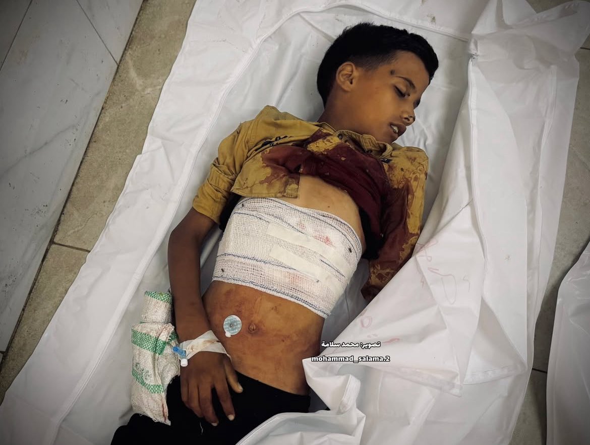 Child Dies from Hunger Seeking Food for Family in Gaza