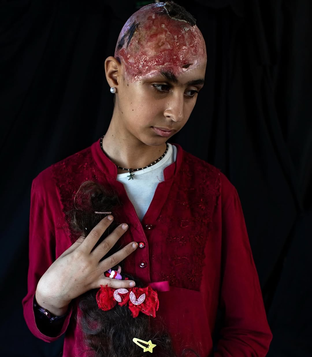 12-Year-Old Gaza Girl Severely Injured in Israeli Airstrike