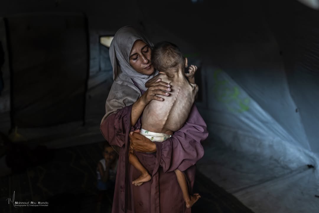 One-Year-Old Palestinian Child Faces Advanced Malnutrition in Gaza
