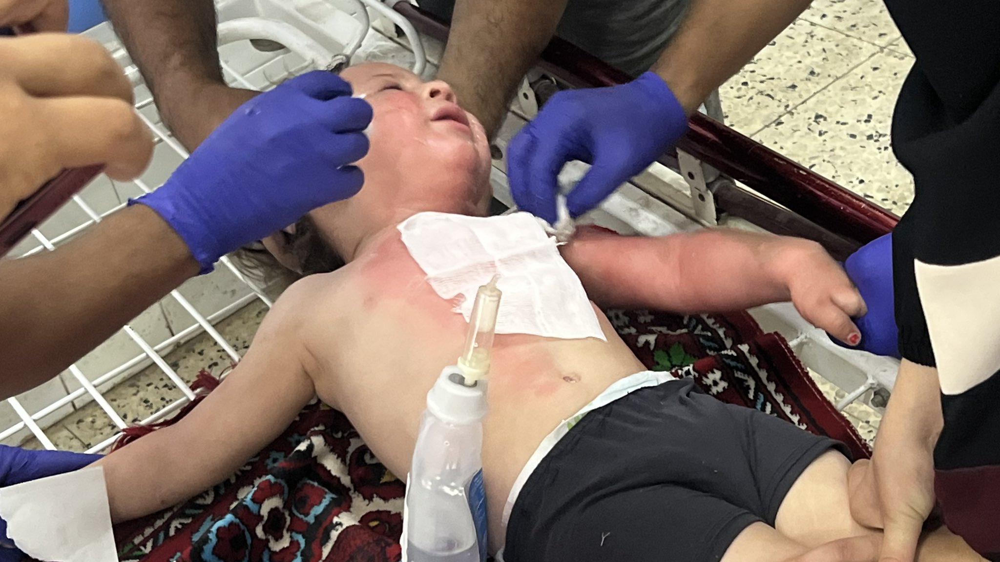Child Odai Cali suffers severe burns from Israeli bombing Gaza City