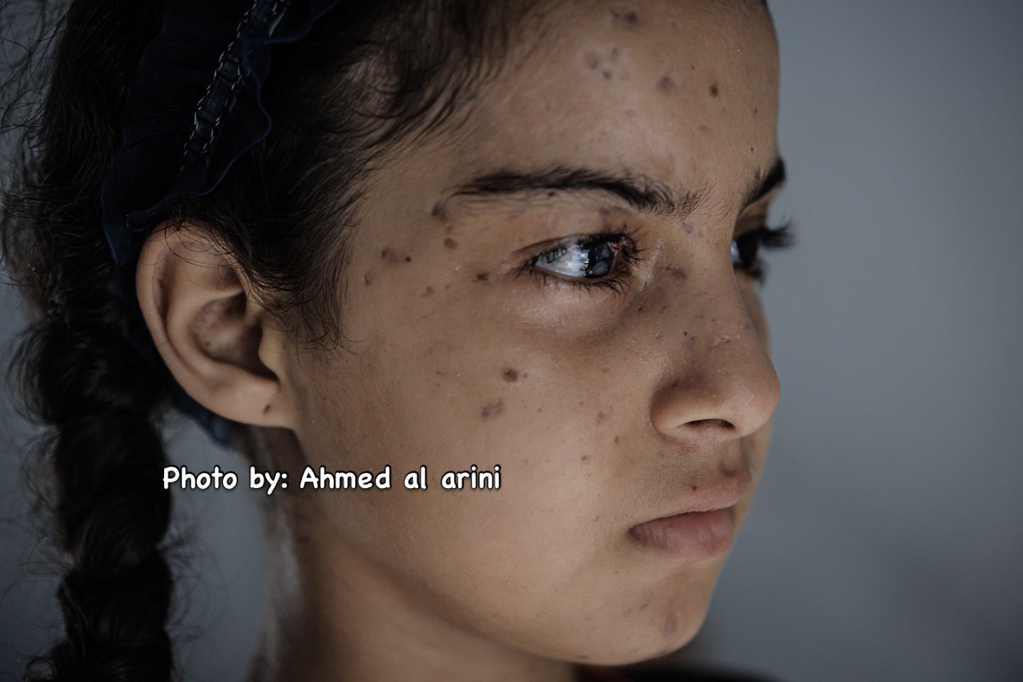Eleven-year-old Maria blinded in Israeli attack loses parents