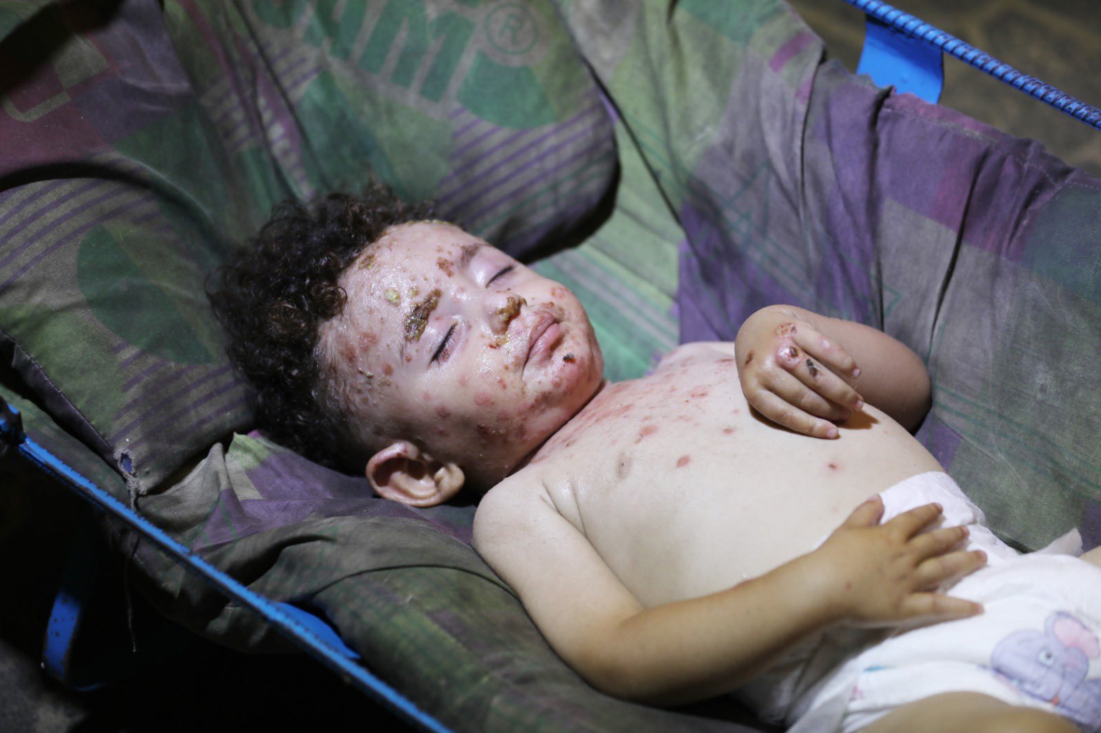 Health Crisis in Gaza Displacement Camps: Disease Outbreaks