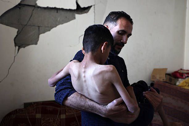 Israeli blockade of Gaza causing malnutrition and illness