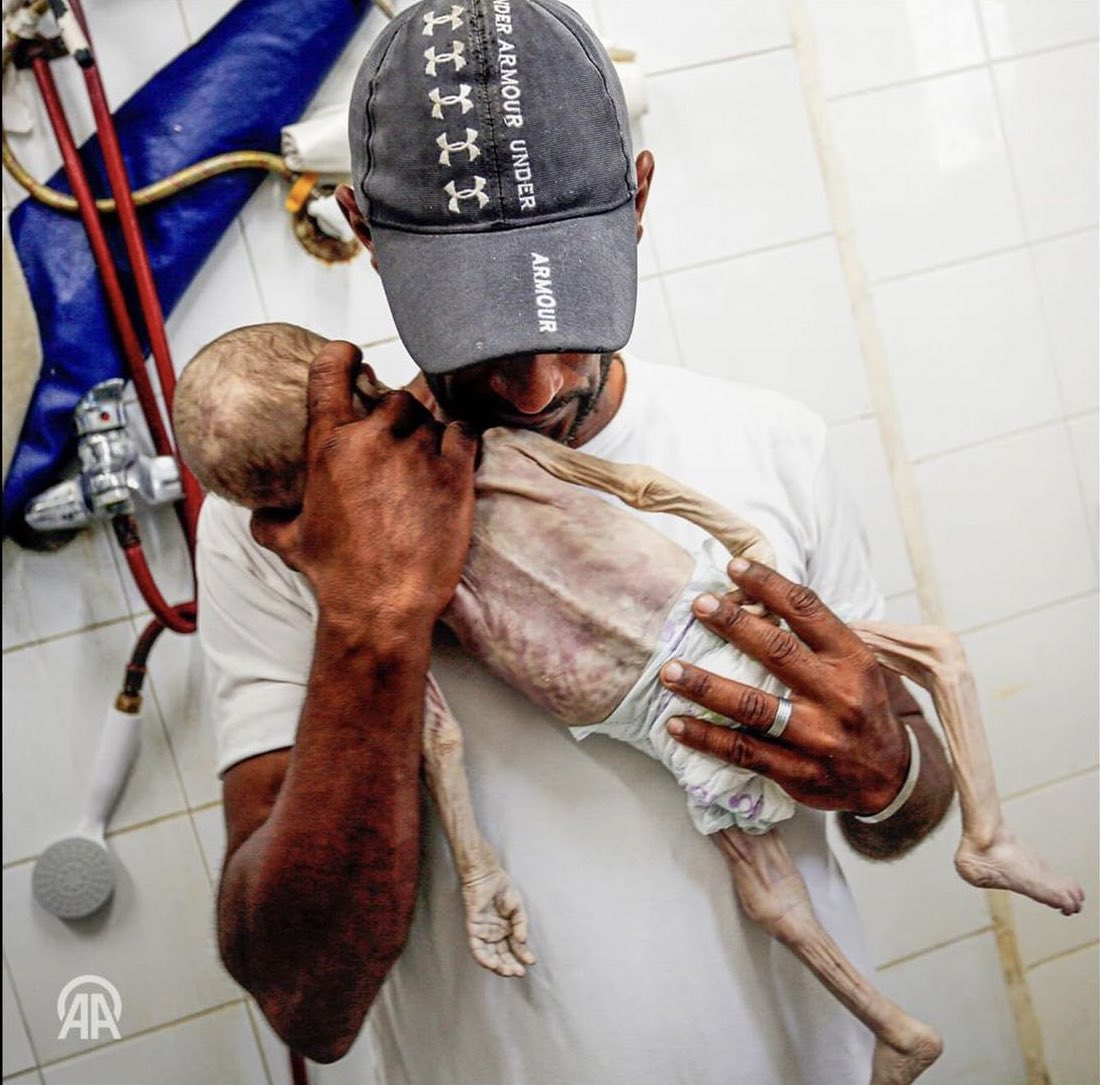 Child Death from Malnutrition During Gaza Humanitarian Crisis