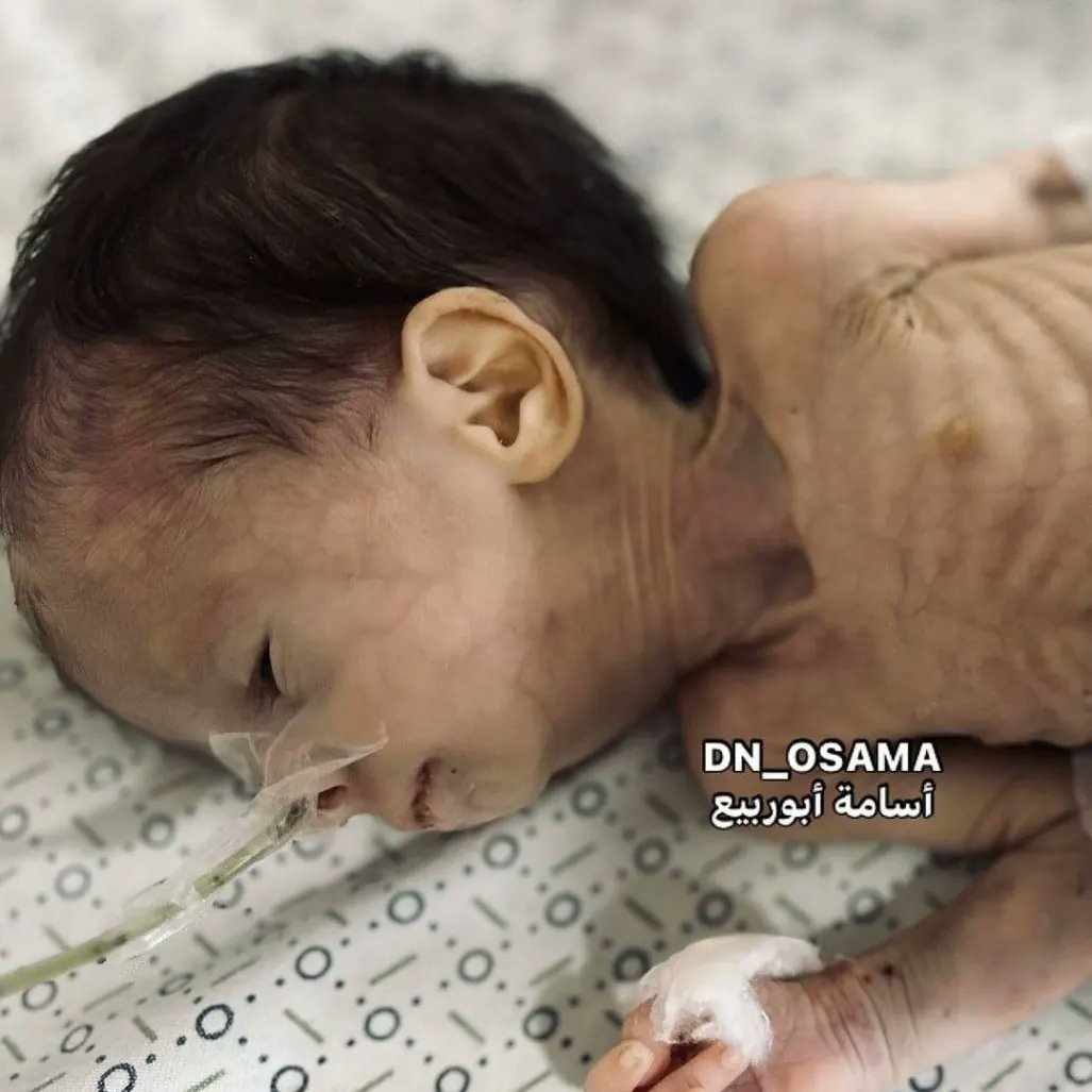 Gaza children starving due to Israeli occupation starvation weapon