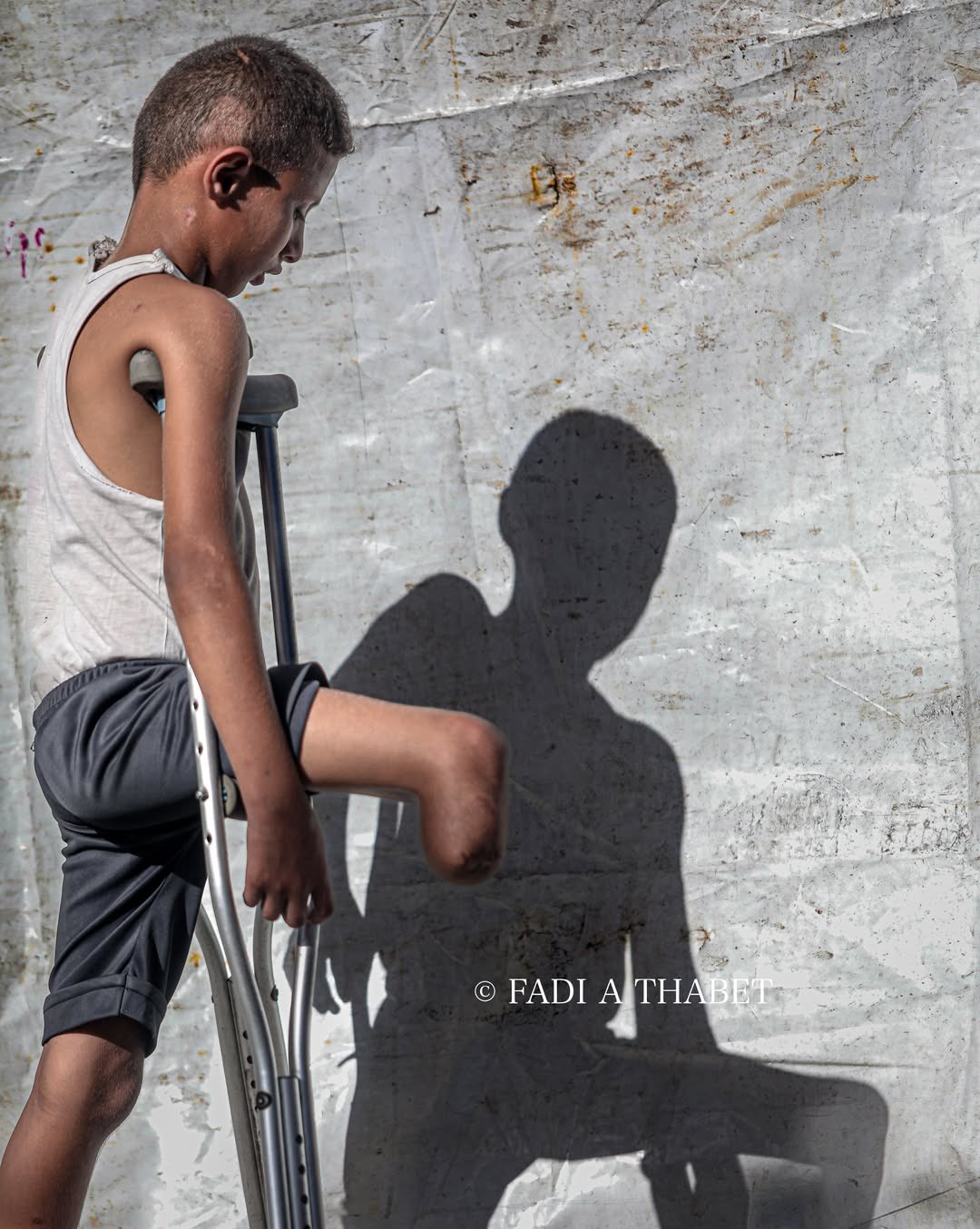 Amputee in Gaza: ‘They amputated my leg… but not my shadow’