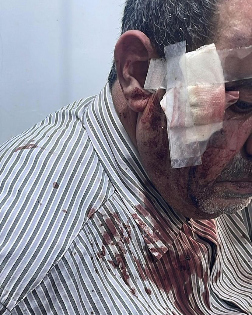 Citizens injured in settler attack in Al-Labn Al-Gharbi village