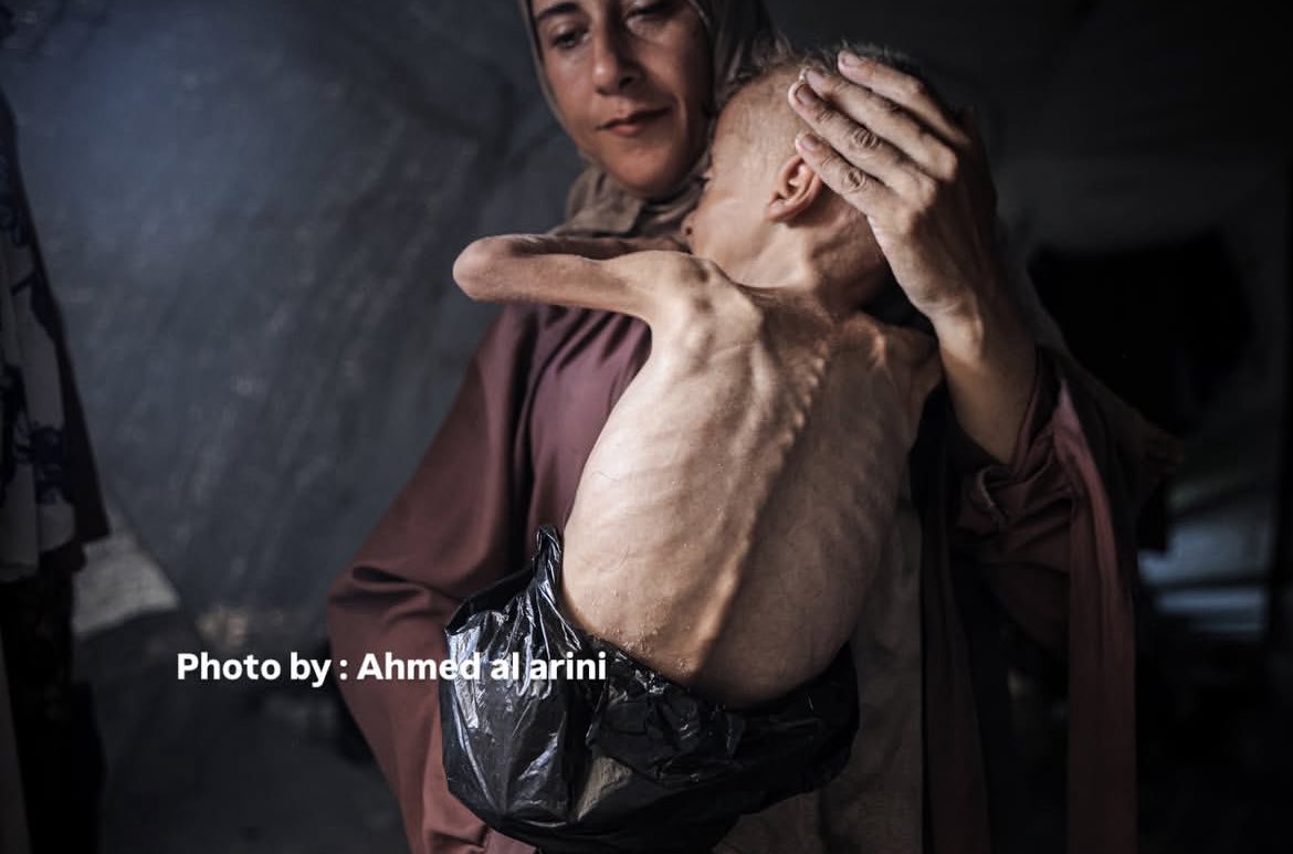 Severe malnutrition crisis affects Gaza’s youngest amid blockade