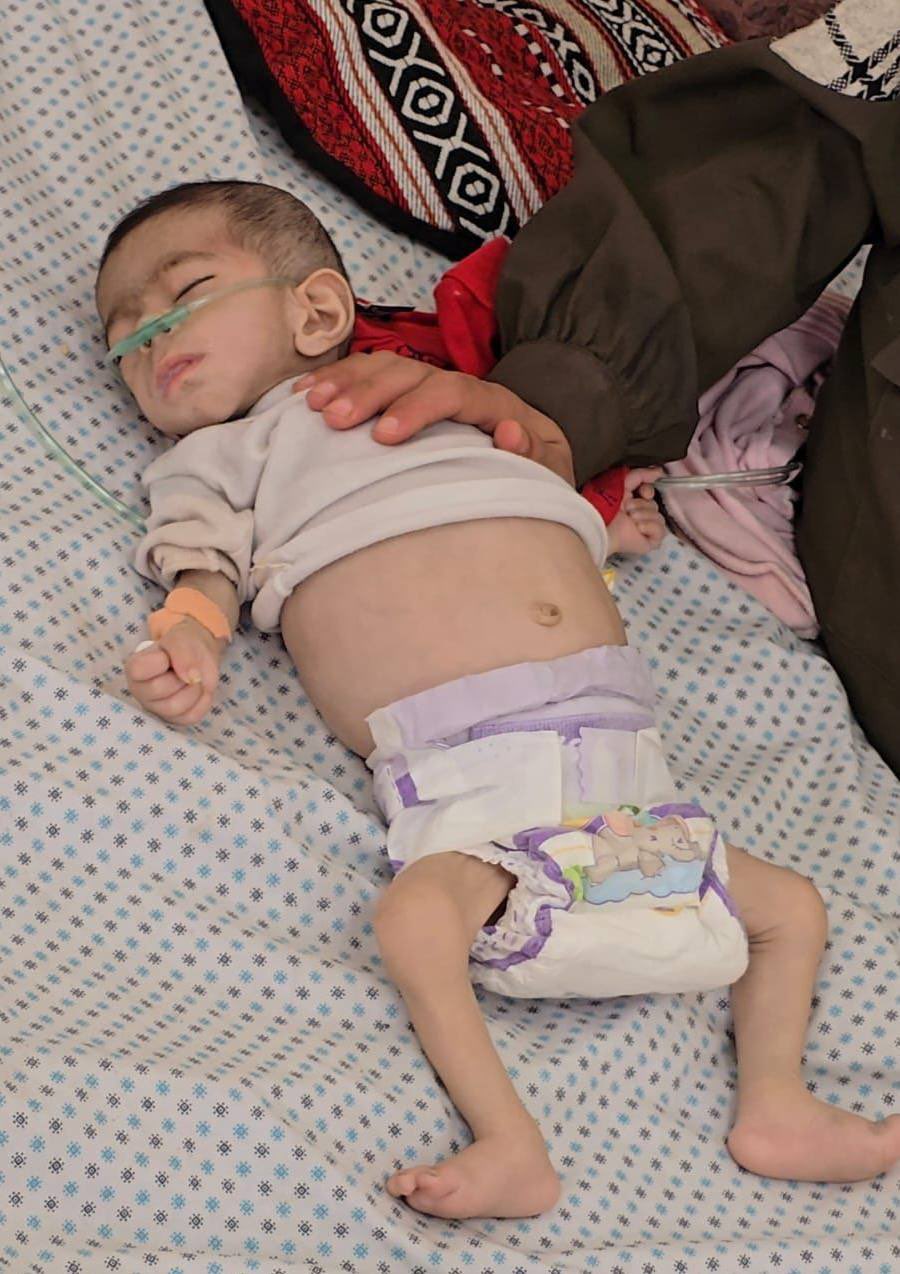 Malnutrition Claims Life of Baby Janan in Gaza