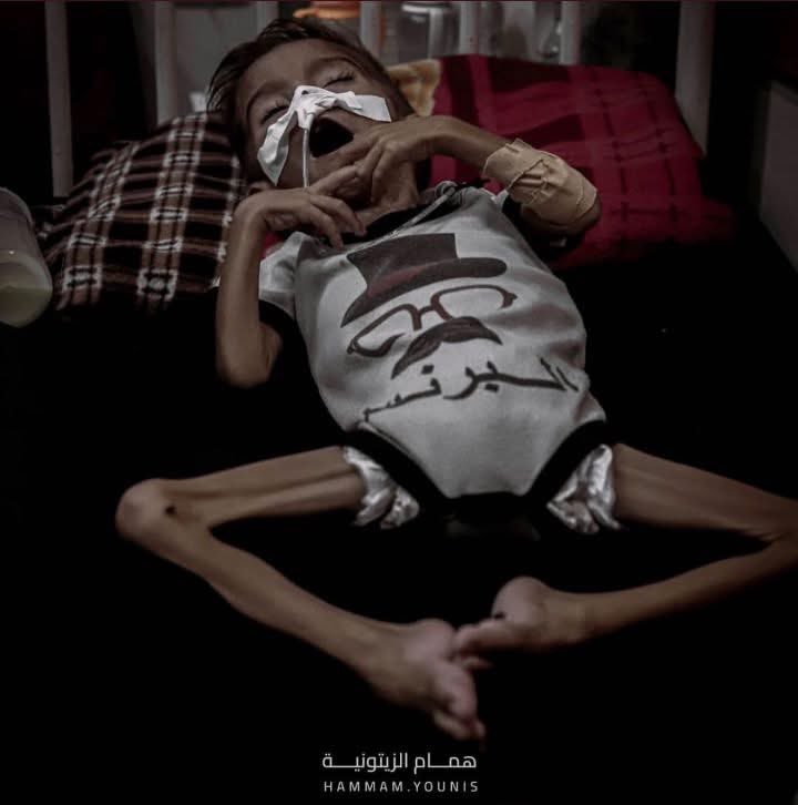 Child Malnutrition Deaths Rise to 193 in Humanitarian Crisis
