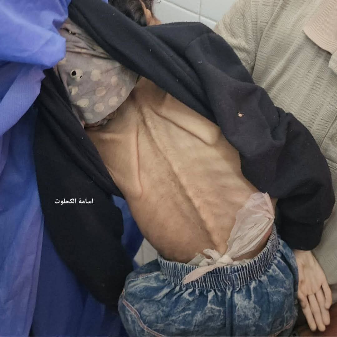 Child Dies of Hunger: Nour Abu Salaa