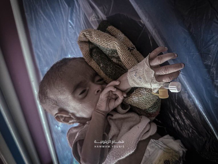 Gaza children starving amid humanitarian crisis